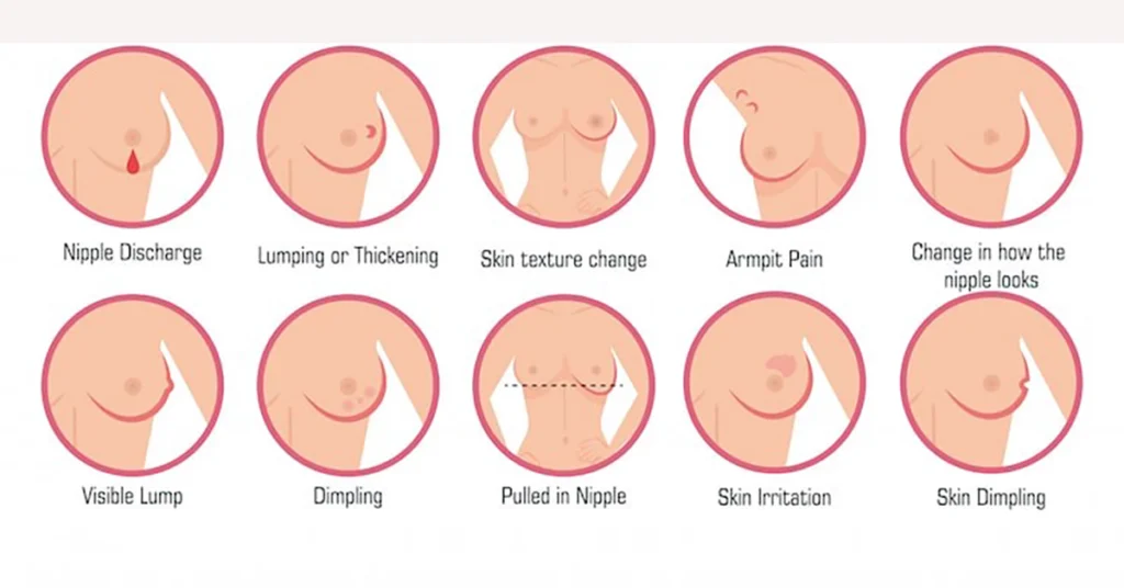 Diagram showing common breast cancer symptoms, including lumps, nipple discharge, and skin dimpling.